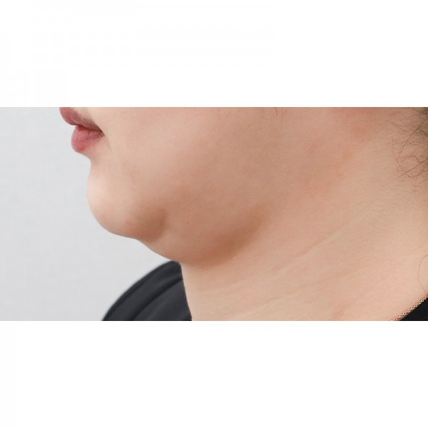 얼굴지방흡입&이중턱근육묶기