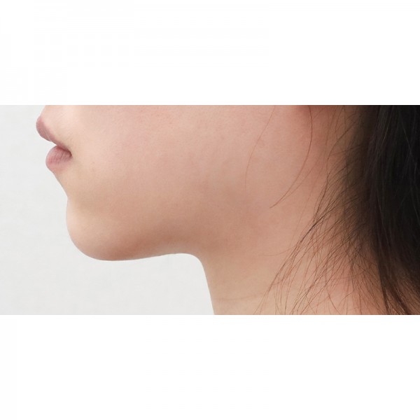 얼굴지방흡입&이중턱근육묶기