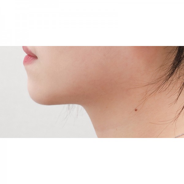 얼굴지방흡입&이중턱근육묶기