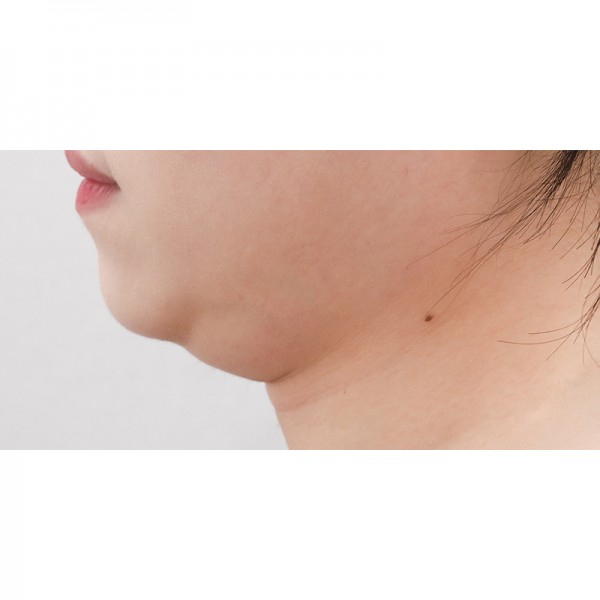 얼굴지방흡입&이중턱근육묶기