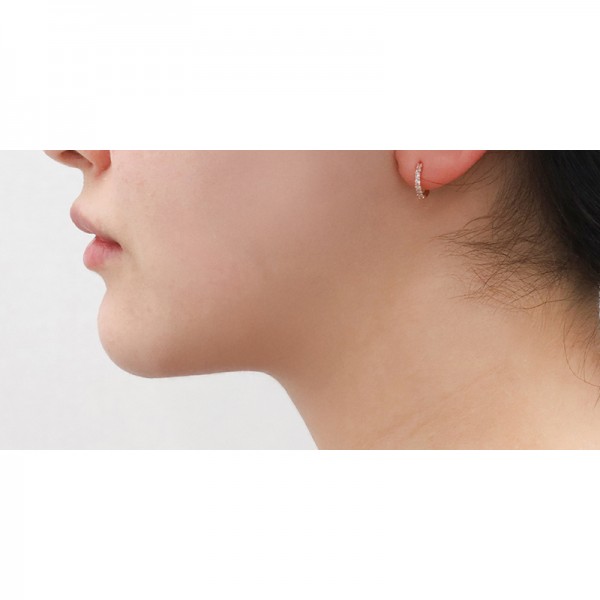 얼굴지방흡입&이중턱근육묶기