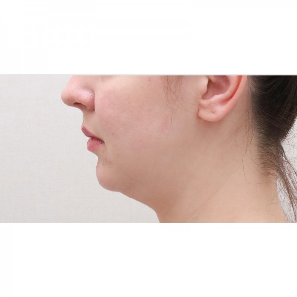 얼굴지방흡입&이중턱근육묶기