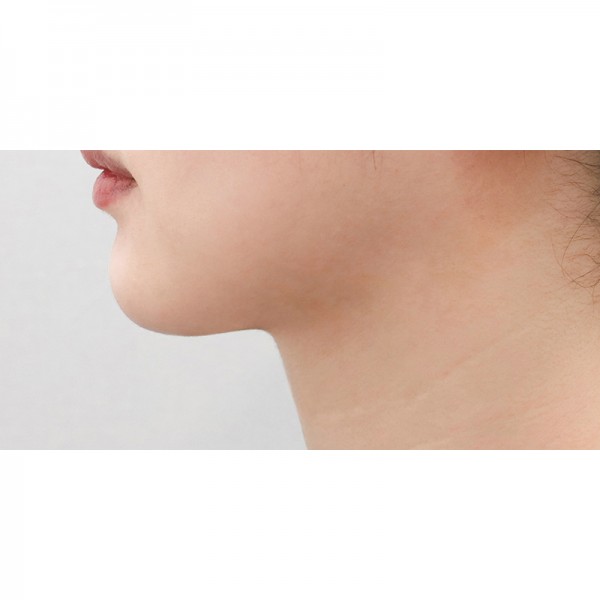 얼굴지방흡입&이중턱근육묶기