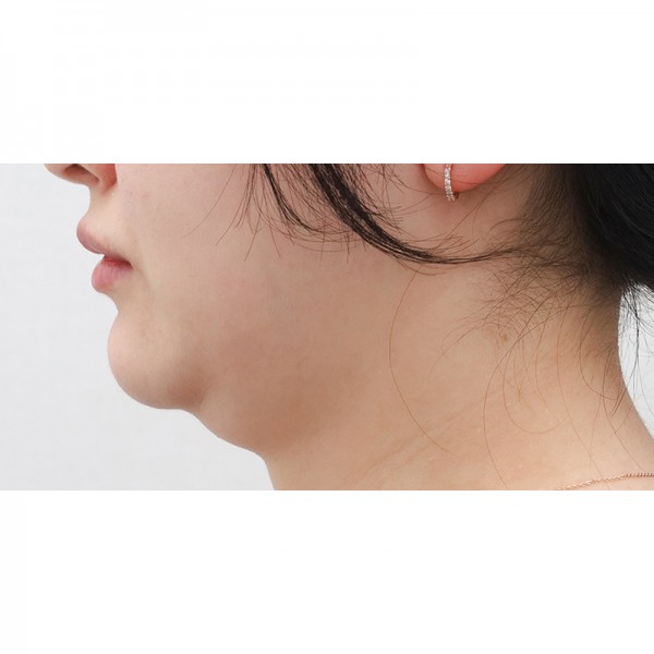 얼굴지방흡입&이중턱근육묶기