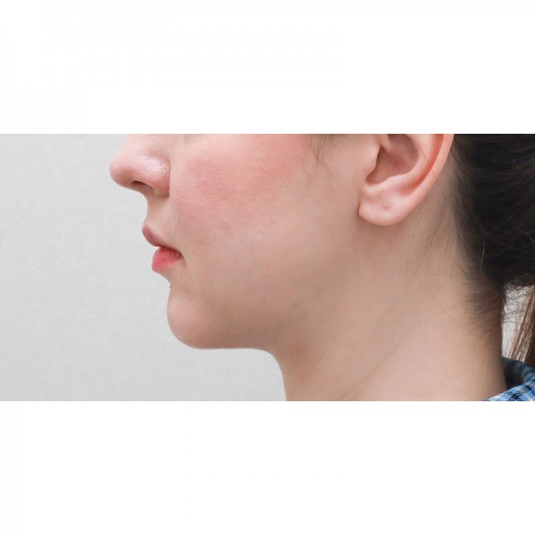 얼굴지방흡입&이중턱근육묶기