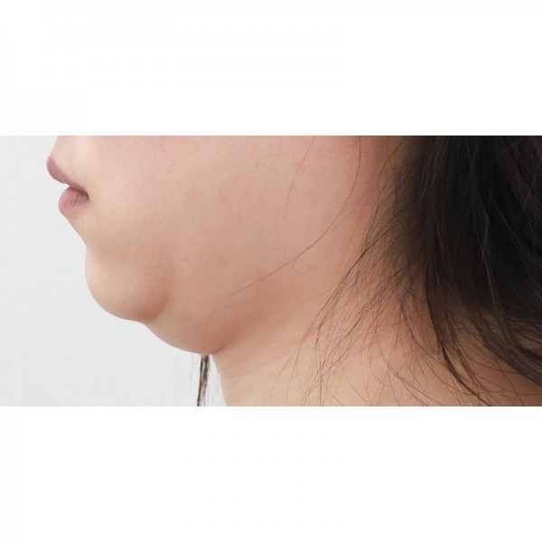 얼굴지방흡입&이중턱근육묶기