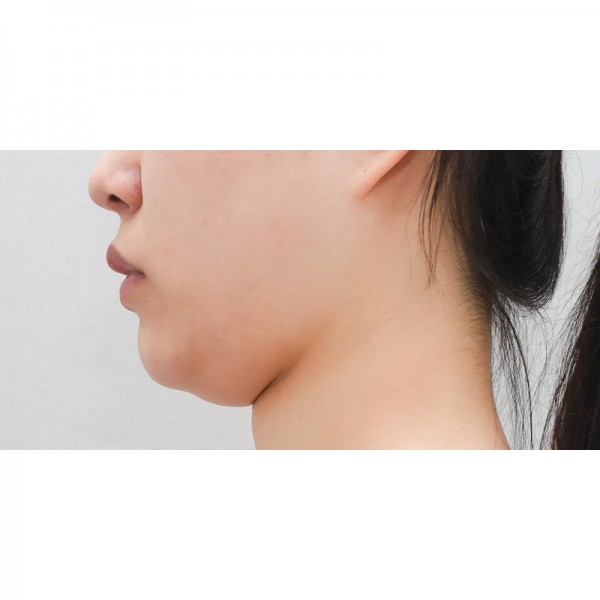 얼굴지방흡입&이중턱근육묶기