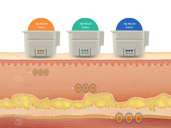 힙,골반필러 클레어 시그니처