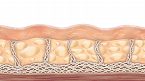 지방추출주사 클레어 시그니처