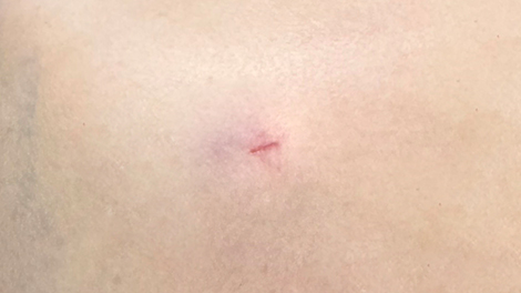 지방추출주사 클레어 시그니처