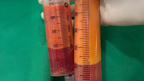 지방추출주사 클레어 시그니처