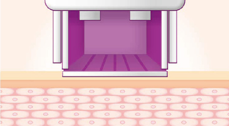 써마지FLX 리프팅