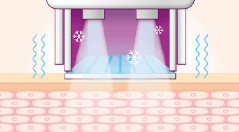 써마지FLX 리프팅