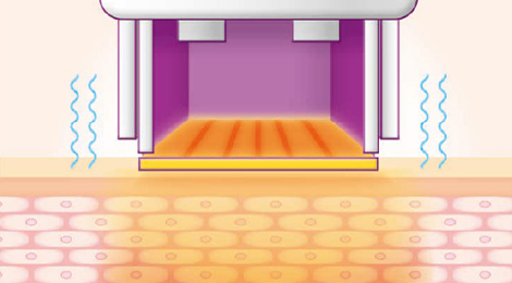 써마지FLX 리프팅